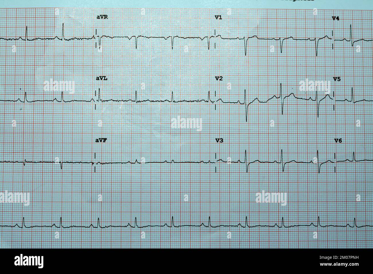 Ein EKG, ein Diagramm, das die Elektrizität des Herzens zieht und eine Vorstellung von der Herzerkrankung und dem Rhythmus gibt und alle ausschließt Stockfoto