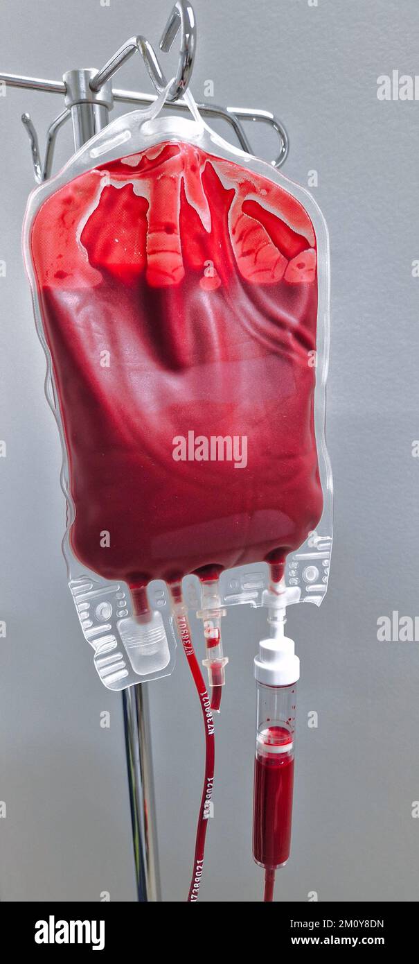 Nahaufnahme einer gepackten roten Blutkörperchen an einem Infusionsständer, Bluttransfusion Stockfoto