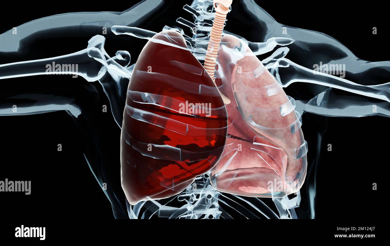 3D Illustration des Hämatothorax, normale Lunge versus kollabiert, Symptome des Hämatothorax, Pleuraerguss, Empyem, Komplikationen nach einer Brustverletzung, ai Stockfoto