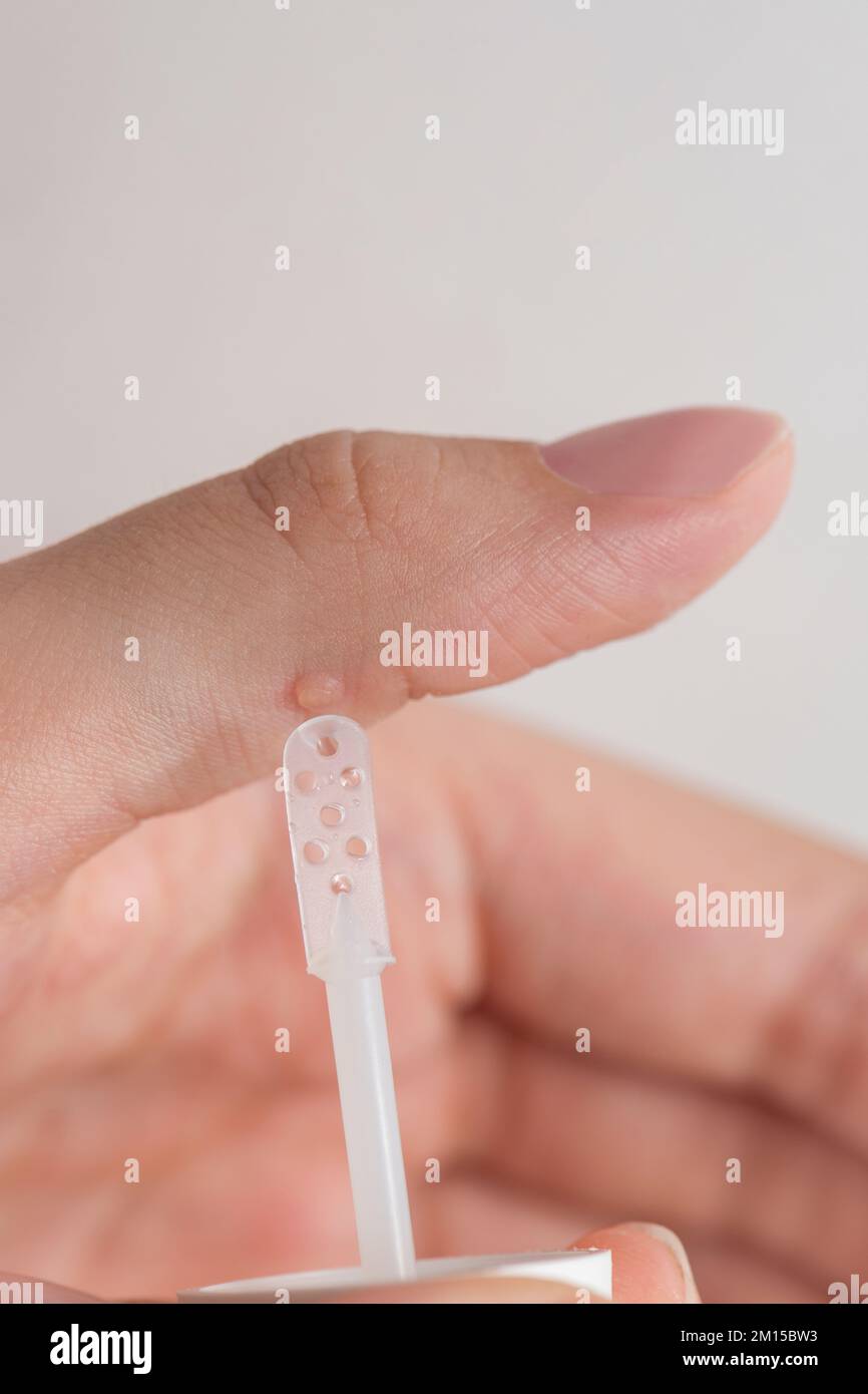 Warzenbehandlung. Der Arzt trägt das Arzneimittel mit einem speziellen Spachtel auf die Warze auf. Beseitigung einer gutartigen Bildung auf der menschlichen Haut mit einem Stockfoto