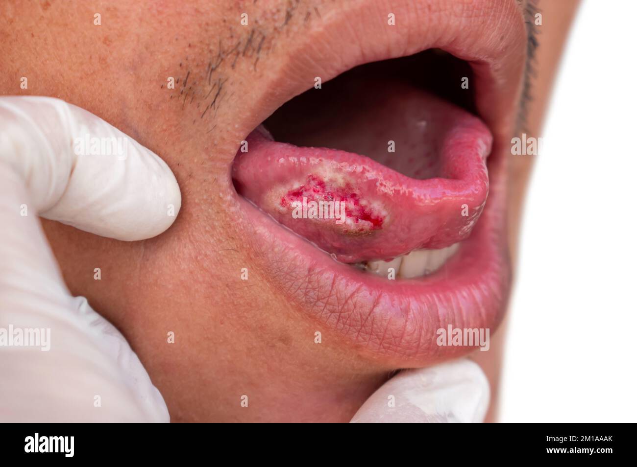 Plattenepithelkarzinom der Zunge. Mundhöhlenkarzinom oder bösartiger Tumor des asiatischen männlichen Patienten. Stockfoto