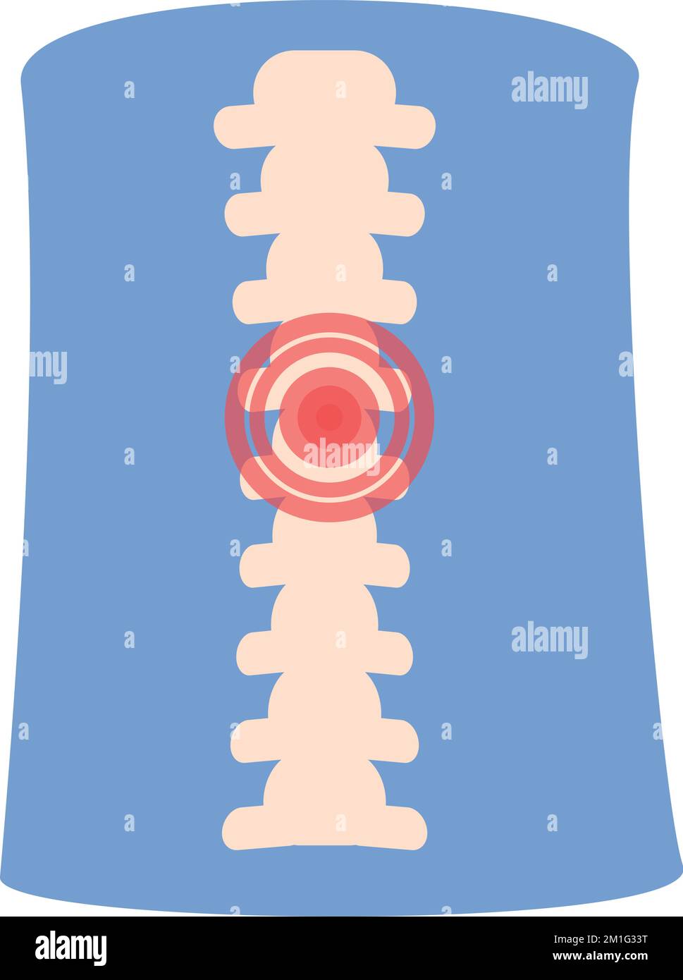 Cartoon-Vektor des Symbols für Wirbelsäulenschmerzen. Arthrosegelenk. Medizinische Behandlung Stock Vektor