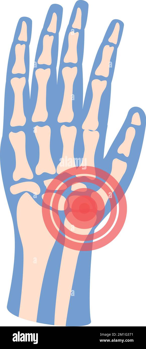 Hand-Arthritis-Symbol-Cartoon-Vektor. Gelenkschmerzen. Medizinischer Patient Stock Vektor