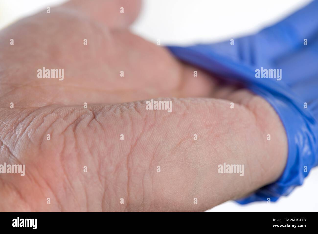 Der Arzt zieht seine blauen Gummihandschuhe aus, die Haut an seinen Händen ist durch Feuchtigkeit zerknittert. Zerknitterte Finger nach längerem Tragen von Gummihandschuhen Stockfoto