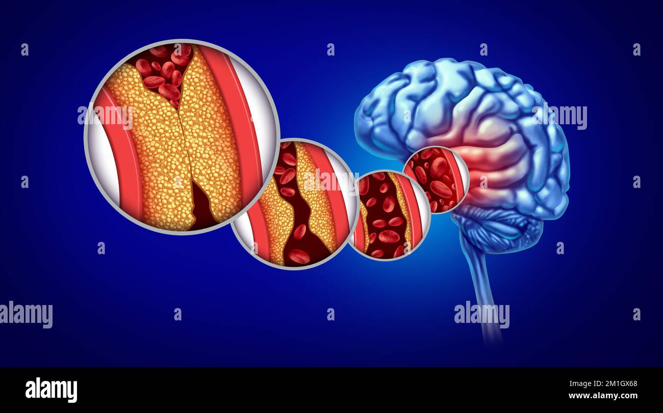 Schlaganfall und Atherosklerose als Gehirnstörung durch Fett- und Cholesterinblockade von Blutzellen als Arterienblockade und Verhärtung Stockfoto