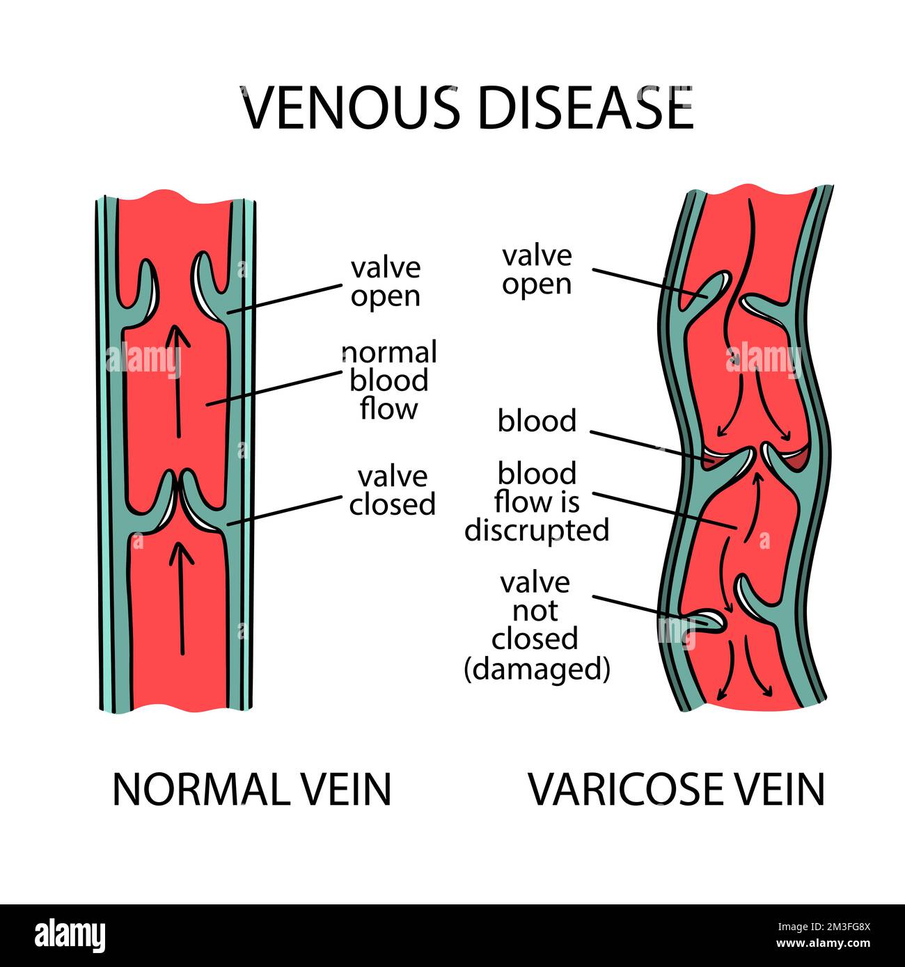 VENENERKRANKUNGEN-SCHEMA Varizen menschlicher Beine Verdrehen und Dilatation der Blutgefäße Schematische Darstellung der Veränderungen in Körperteilen Medical Ed Stock Vektor