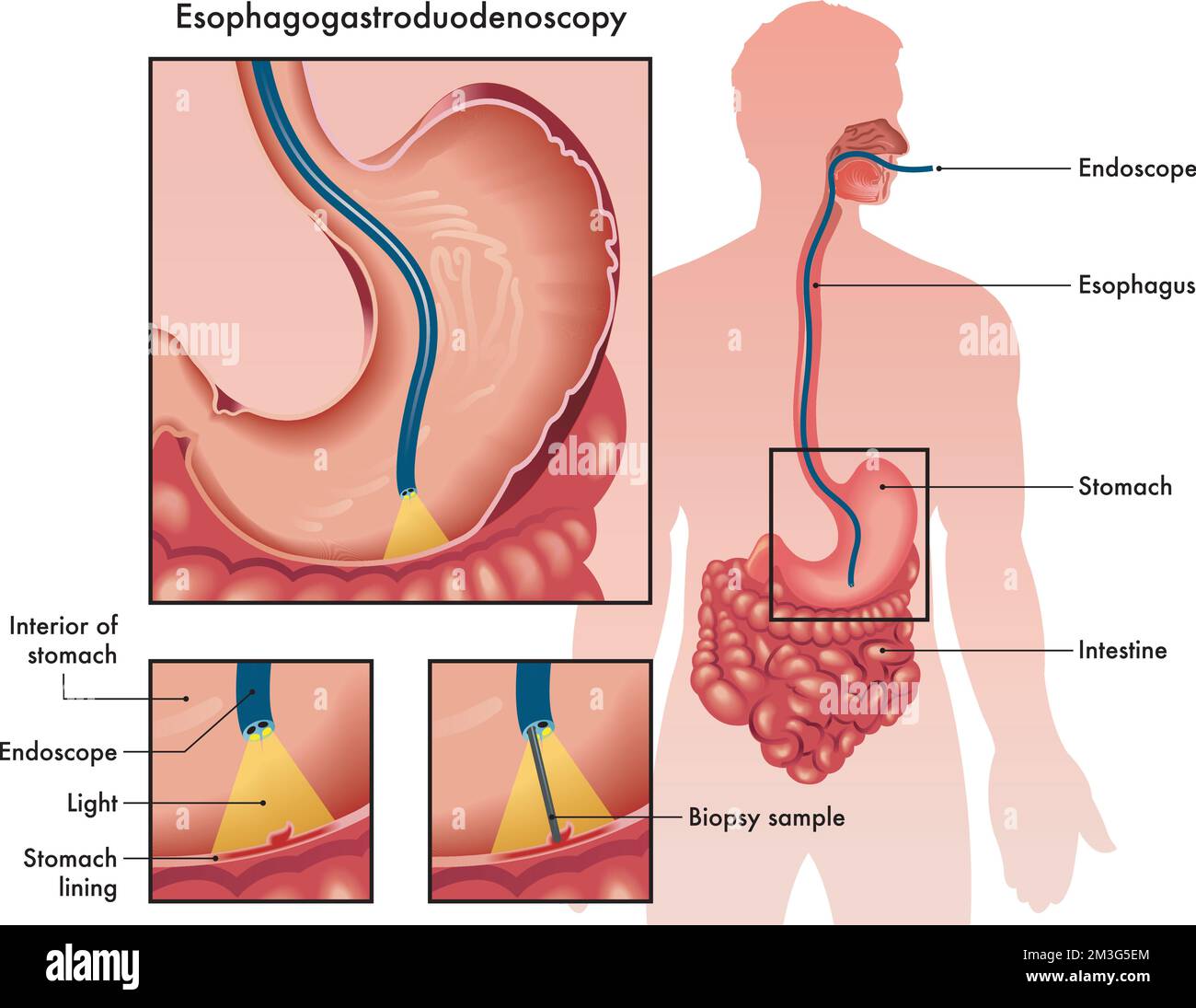 Medizinische Illustration einer Osophagogastroduodenoskopie mit zwei Details, die das Verfahren und die verwendeten Instrumente zeigen, mit Anmerkungen. Stock Vektor