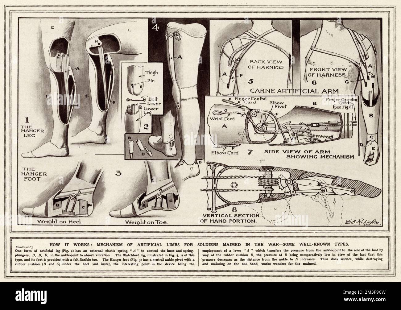 Das Diagramm zeigt eine Montage von drei verschiedenen Arten von künstlichen Gliedmaßen, die für verwundete Soldaten im Ersten Weltkrieg verfügbar sind. Künstliches Bein, kontrolliert mit äusserer elastischer Schnur vom Knie bis zum Sprunggelenk. Der Blatchford-Fuß ist mit einem elastischen Zehenbereich aus Filz ausgestattet. Der Aufhängefuß verfügt über einen zentralen Knöchelgelenk mit einem Gummipolster unter Ferse und Spann. Es wurde geschätzt, dass eine Million Männer im Ersten Weltkrieg Gliedmaßen verloren. Datum: 1915 Stockfoto