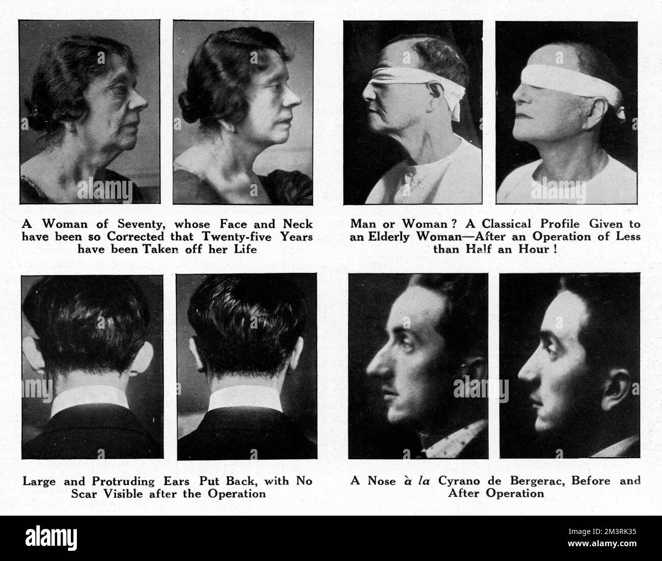 Beispiele von Patienten, die sich in den 1920er Jahren einer plastischen Operation unterzogen haben, um einen Artikel im Magazin "The Sphere" mit dem Titel "New Faces for Old" zu begleiten. 1927 Stockfoto