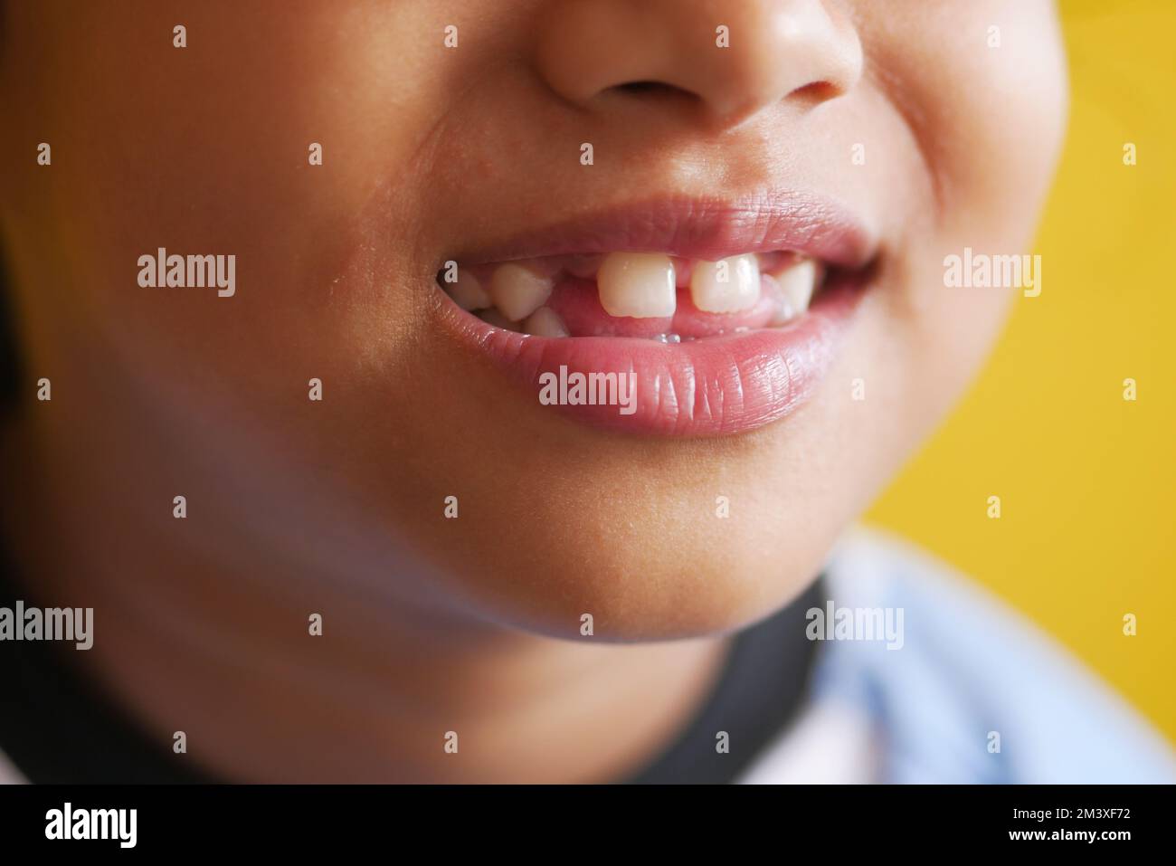 Deformed teeth Fotos und Bildmaterial in hoher Auflösung Alamy