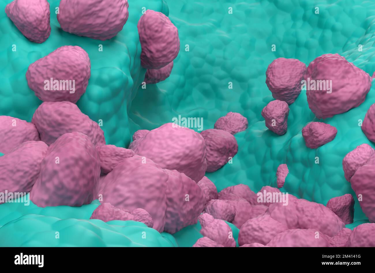 Nicht-kleinzelliges Lungenkarzinom (NSCLC) im Lungengewebe - 3D-Darstellung in der Nahaufnahme Stockfoto