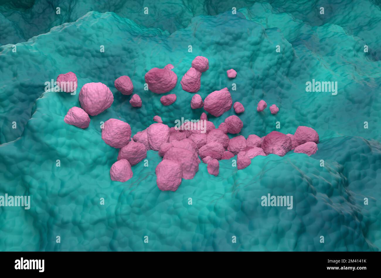 Nicht-kleinzelliges Lungenkarzinom (NSCLC) im Lungengewebe - isometrische 3D-Darstellung Stockfoto