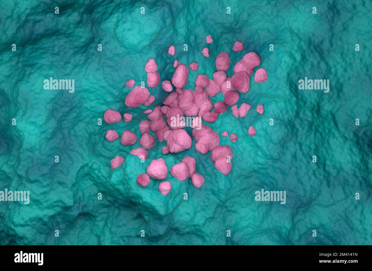 Nicht-kleinzelliges Lungenkarzinom (NSCLC) im Lungengewebe – Draufsicht 3D Abbildung Stockfoto
