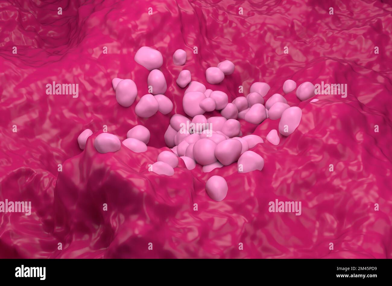 Nicht-kleinzelliges Lungenkarzinom (NSCLC) im Lungengewebe - isometrische 3D-Darstellung Stockfoto