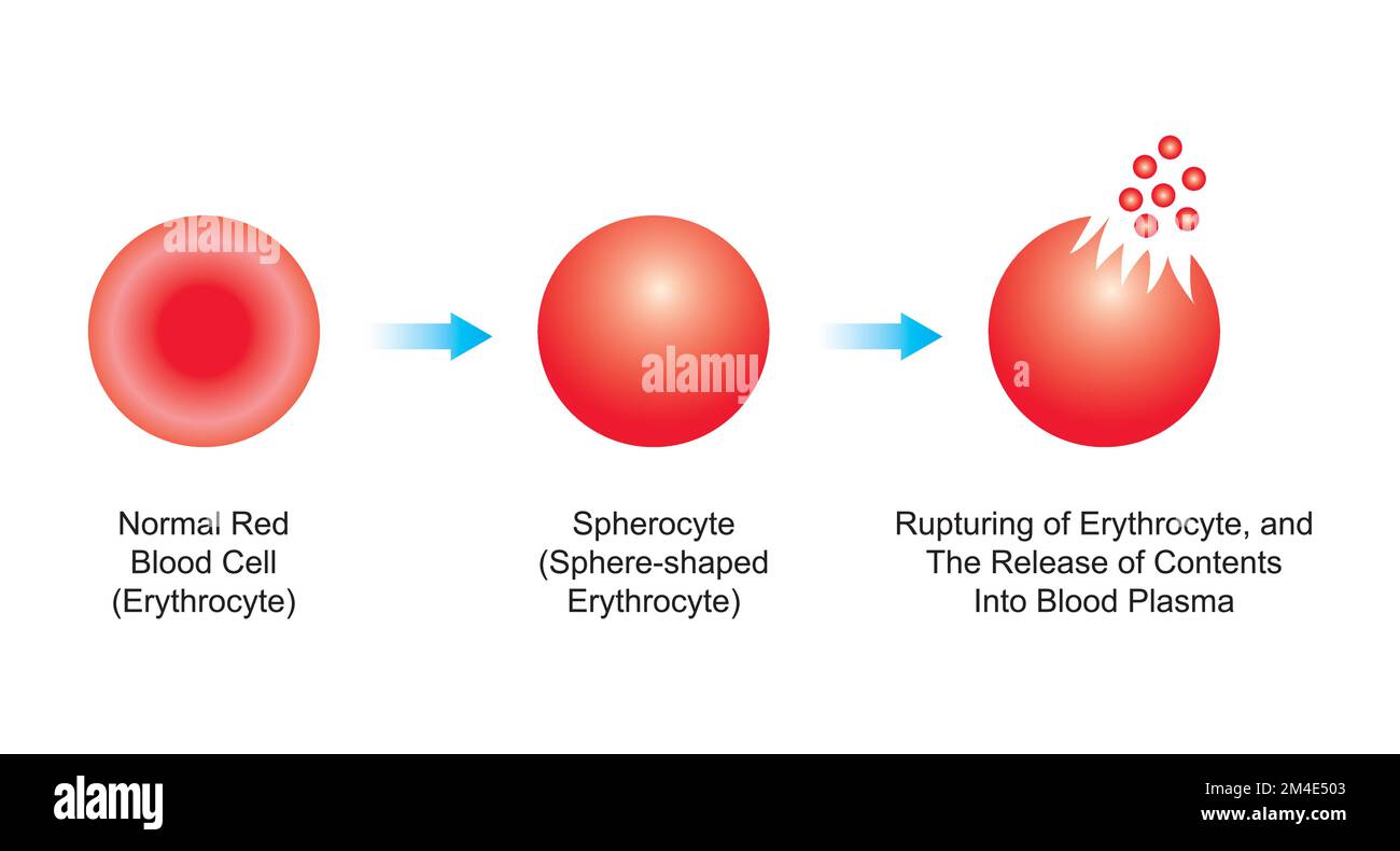 Wissenschaftliches Design der Hämolyse. Die Zerstörung roter Blutkörperchen. Bunte Symbole. Vektordarstellung. Stock Vektor