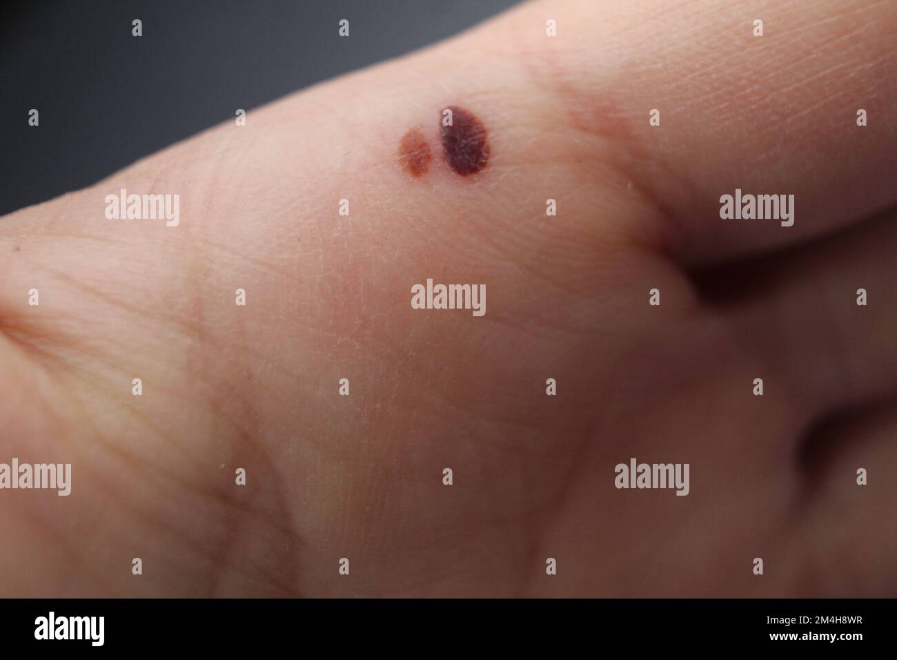 Ein Fehler in der Haut an der Hand der Handfläche. Bluterguss an der Handfläche. Hautschäden. Menschliche Haut Hand Gesundheit Stockfoto