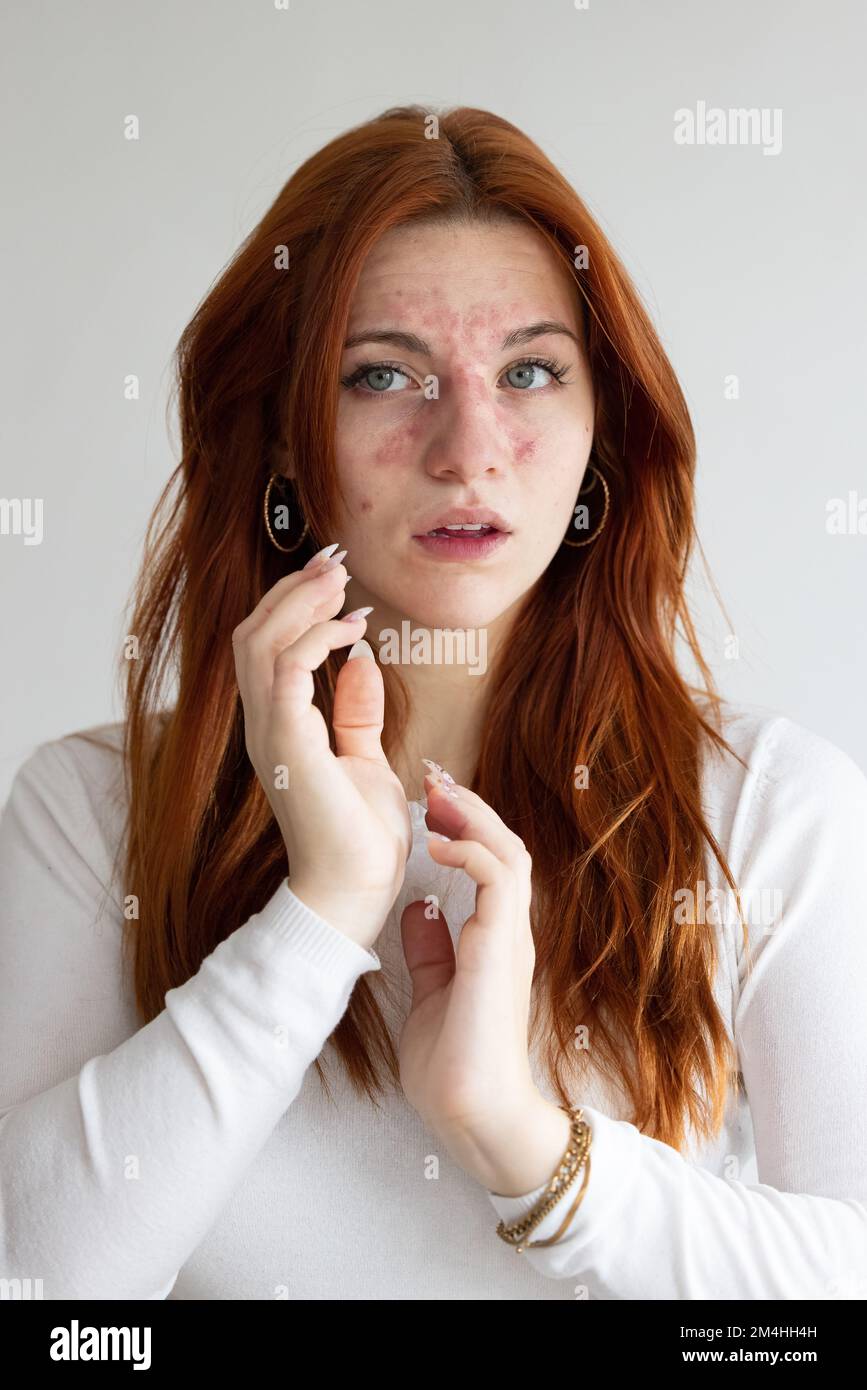 Junge Weiße mit allergischer Reaktion durch Bienenstich im Gesicht. Rötung und Juckreiz im Gesicht. Gefahr des anaphylaktischen Schocks Stockfoto