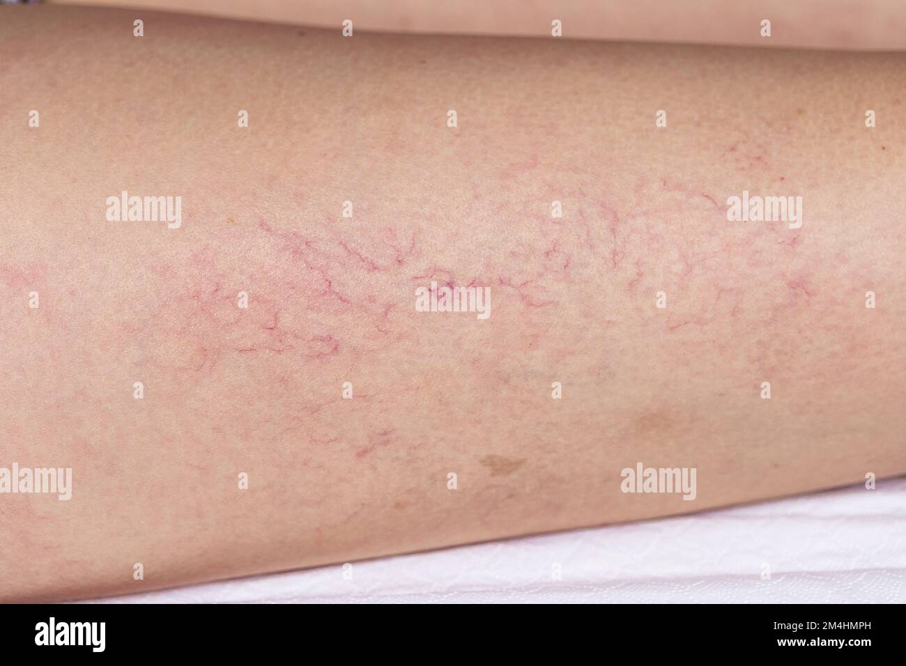 Venas dilatadas -Fotos und -Bildmaterial in hoher Auflösung – Alamy