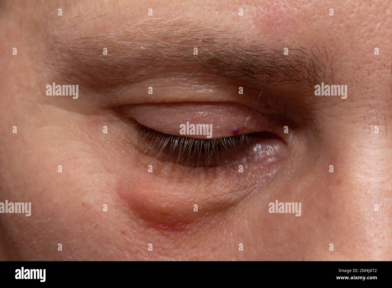 Plötzliche Schwellung Unter Dem Auge www.alamy.de