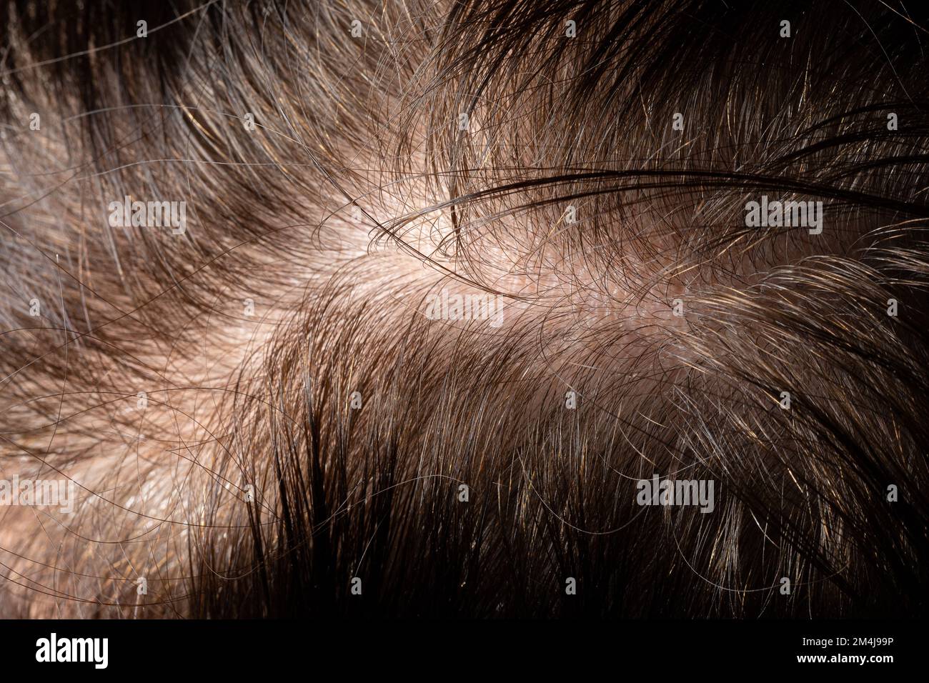 Weibliche Kopfhaut mit Glatze und Haarverlustproblemen. Seborrhoische Dermatitis, die Haare