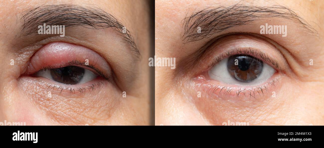 Das weibliche Auge vor und nach der Stye-Behandlung. Geschwollenes Auge auf dem Augenlid, das dann aufgepumpt und gesund erscheint Stockfoto