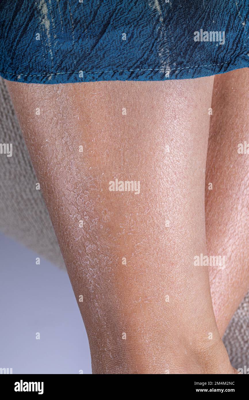Die Beine der Frau schälen sich durch übermäßig trockene und dehydrierte Haut. Flüssigkeitsmangel nach dem Sonnenbaden. Schäden durch UV-Strahlen. Stockfoto