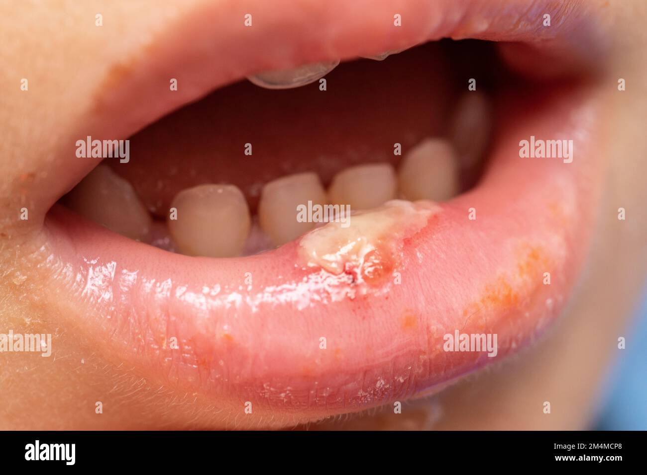 Kind mit geschwollener Unterlippe windet eine Eiterinfektion, die Geschwüre im Mund verursacht. Stockfoto