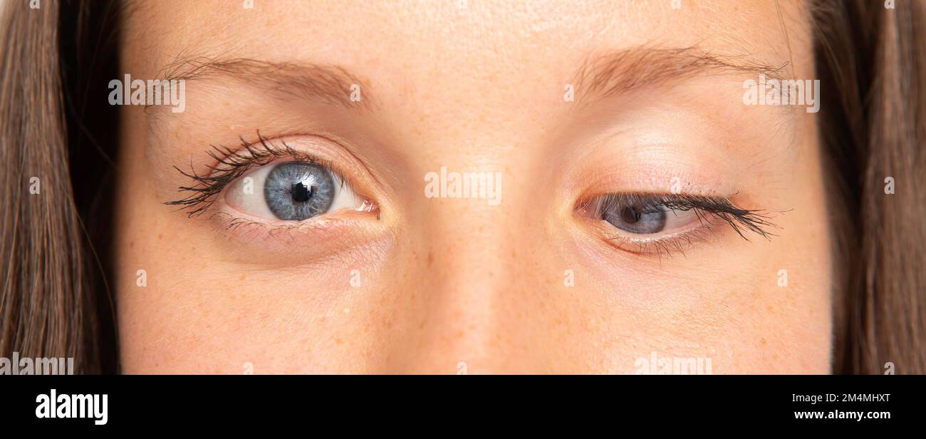 Makro der Augen eines jungen Mädchens mit herabhängendem Augenlid und Schielen. Das Floppy-Lid-Syndrom Stockfoto