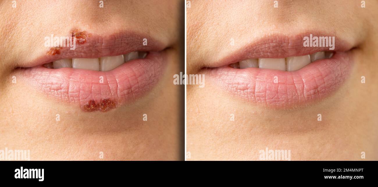 Lippenverschlüsse einer Frau vor und nach Lippenherpes-Behandlung, Herpes simplex. Detail mit und ohne Narbe und Pusteln Stockfoto