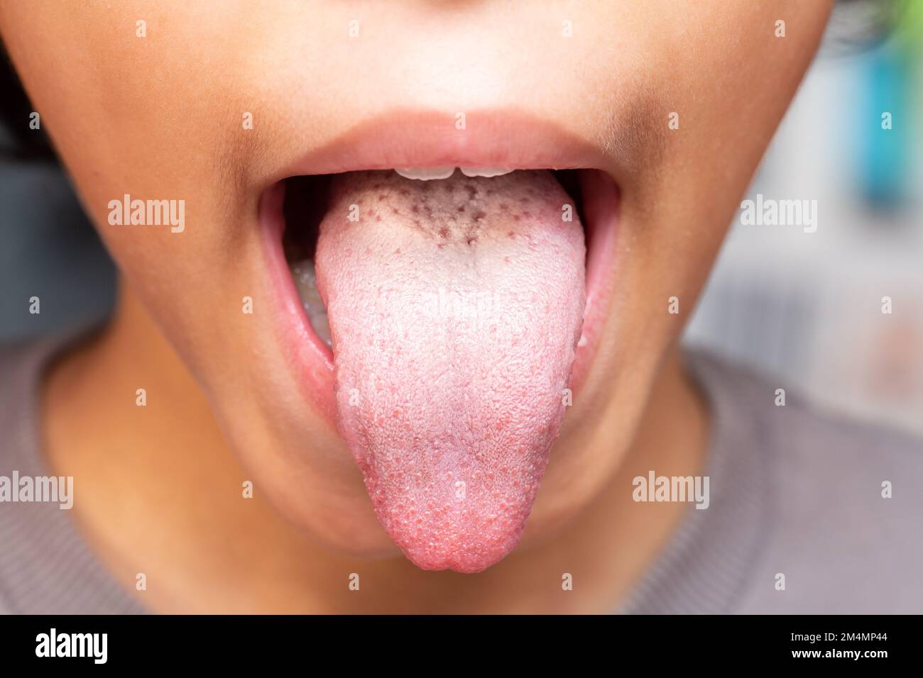 Nahaufnahme Weißes Mädchen zeigen ihre Zunge für Arzt Check weiße Zunge.Konzept für Symptome von Virus, Krankheit und Bakterien in Zunge Konzept Stockfoto