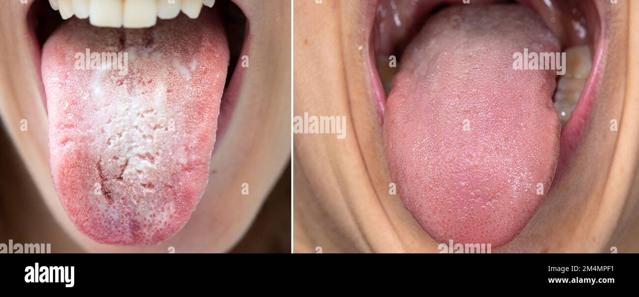 Die Zunge einer Frau, die aus ihrem Mund ragt. Vergleich zwischen einer gesunden Zunge und einer mit Candidiasis und bakterieller Patina. Hygiene und ha Stockfoto