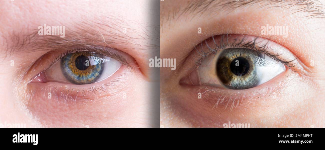 Zwei verschiedene Fälle von Heterochromie am Auge zweier Frauen. Makro der blauen und braunen Augeniris. Stockfoto