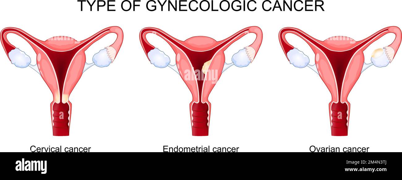 Typ des gynäkologischen Karzinoms. Ovarial-, Endometrium- und Zervixkarzinom. Das Diagramm zeigt den Querschnitt des Uterus mit verschiedenen Teilen einer Frau Stock Vektor