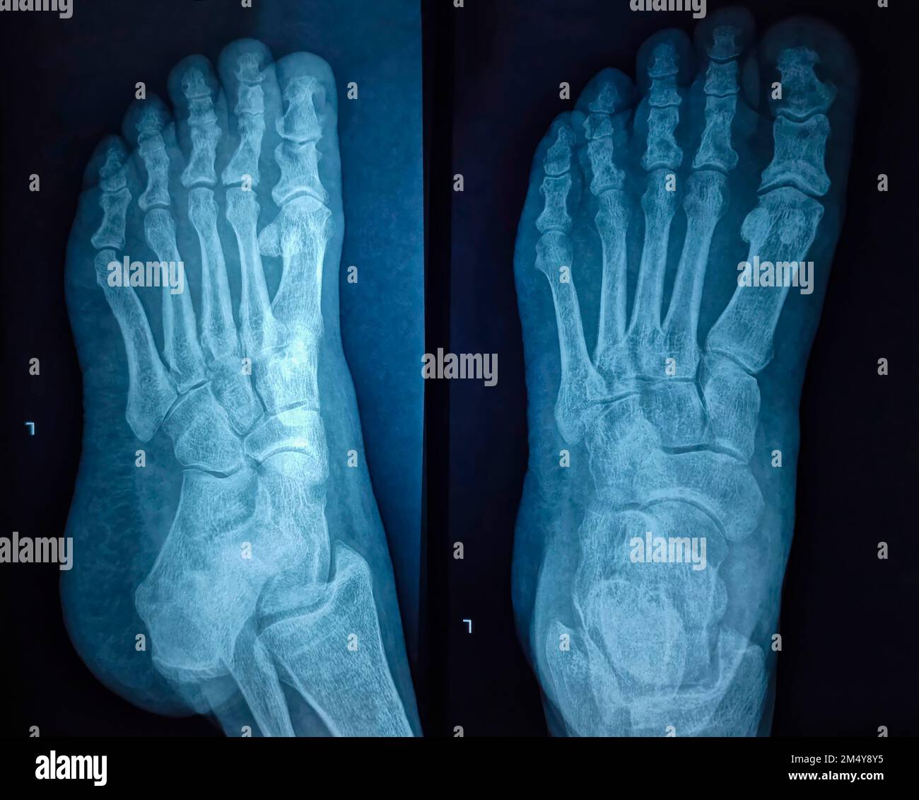 Röntgenbild des Fusses, Röntgenbild der Speiseröhre. Stockfoto