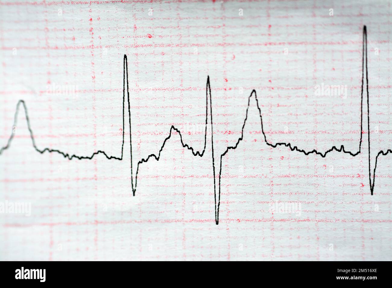 EKG-EKG-Papier, das den normalen Sinusrhythmus NSR mit häufigen PACS ...