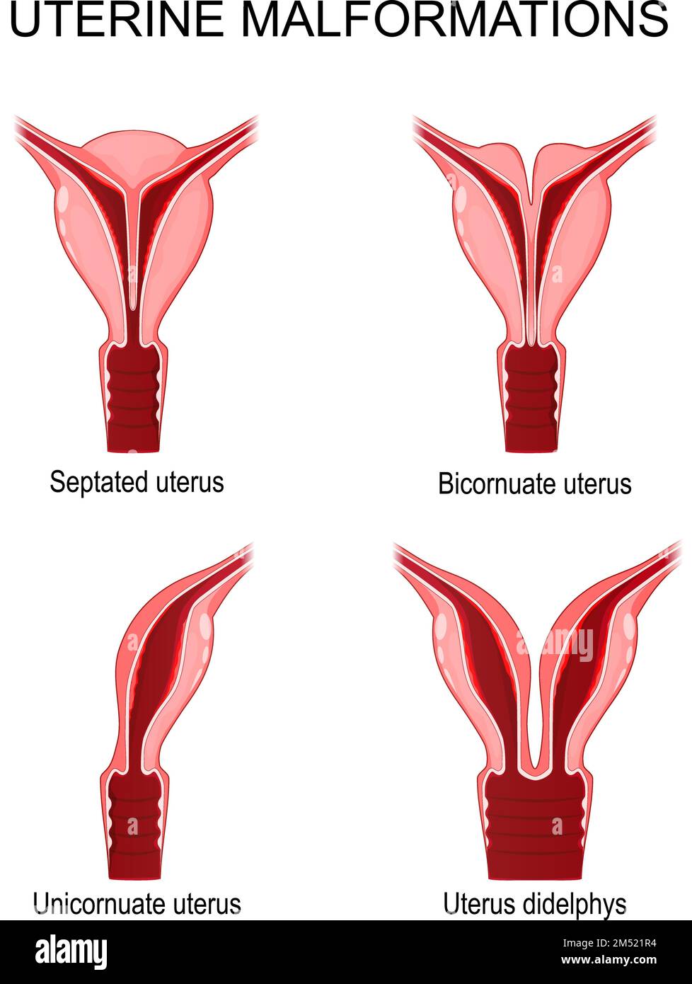 Missbildungen des Uterus. Unicornuat, Didelphys, Bicornuat und septierter Uterus. Vektorposter für medizinische Zwecke Stock Vektor