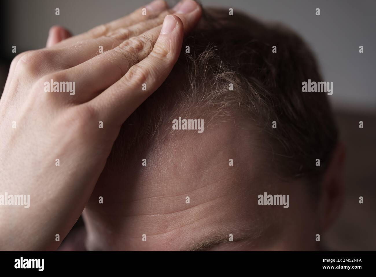 Männer Haarausfall Problem Alopezie, Nahaufnahme Flachfokus Foto Stockfoto