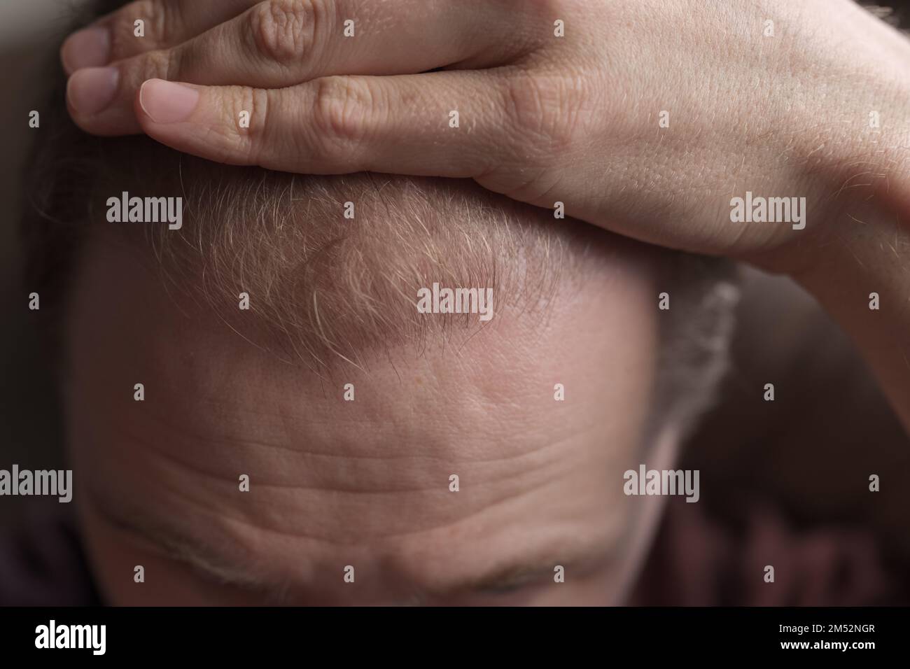 Männer Haarausfall Problem Alopezie, Nahaufnahme Flachfokus Foto Stockfoto