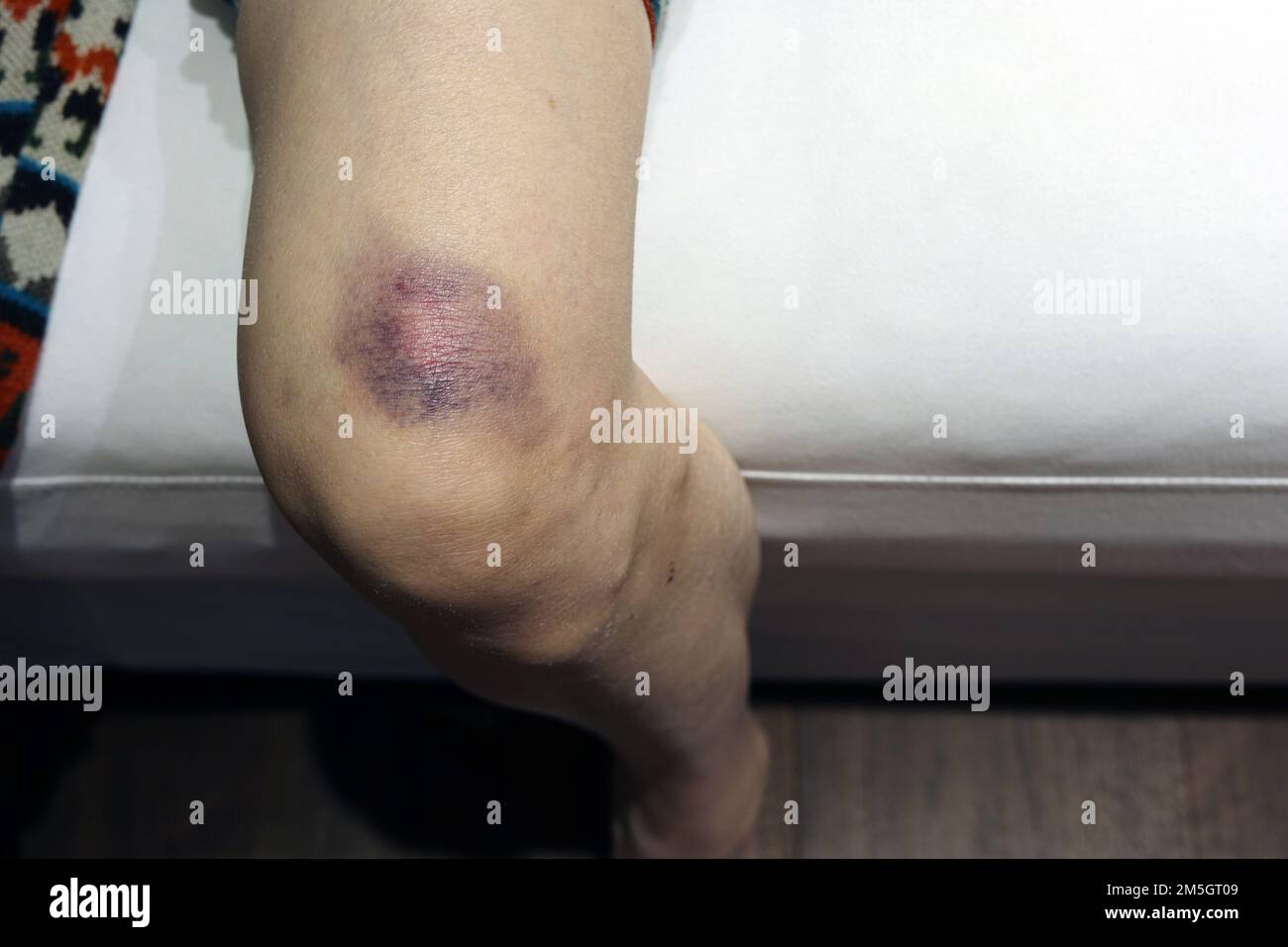 Blaue Flecken auf der Haut ihres Beins Stockfoto