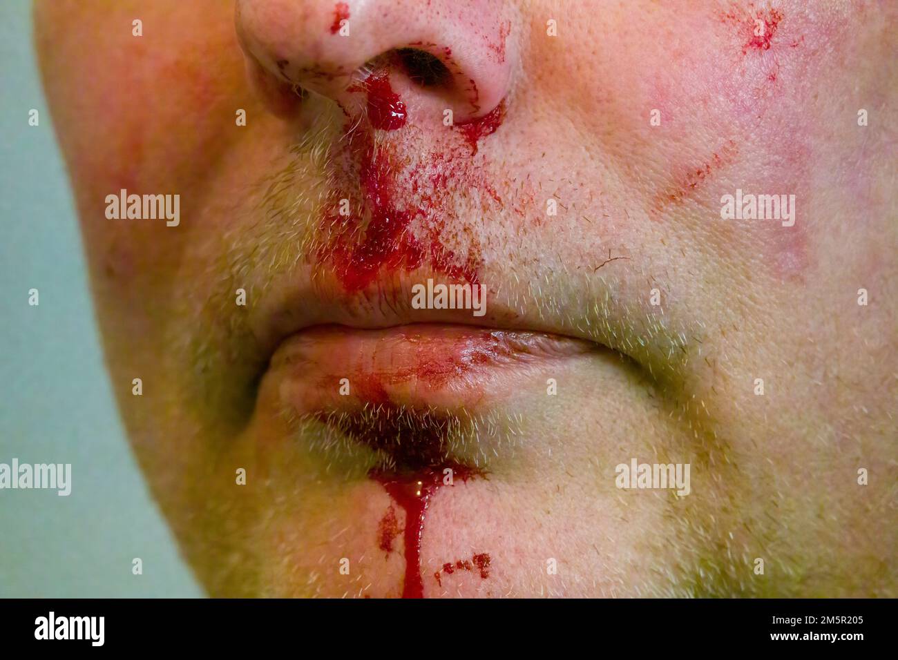 Nasenbluten. Weißer Mann mit Nasenbluten. Porträt eines Mannes mit gebrochener Nase. Konzept für Gesundheit oder Gewalt Stockfoto