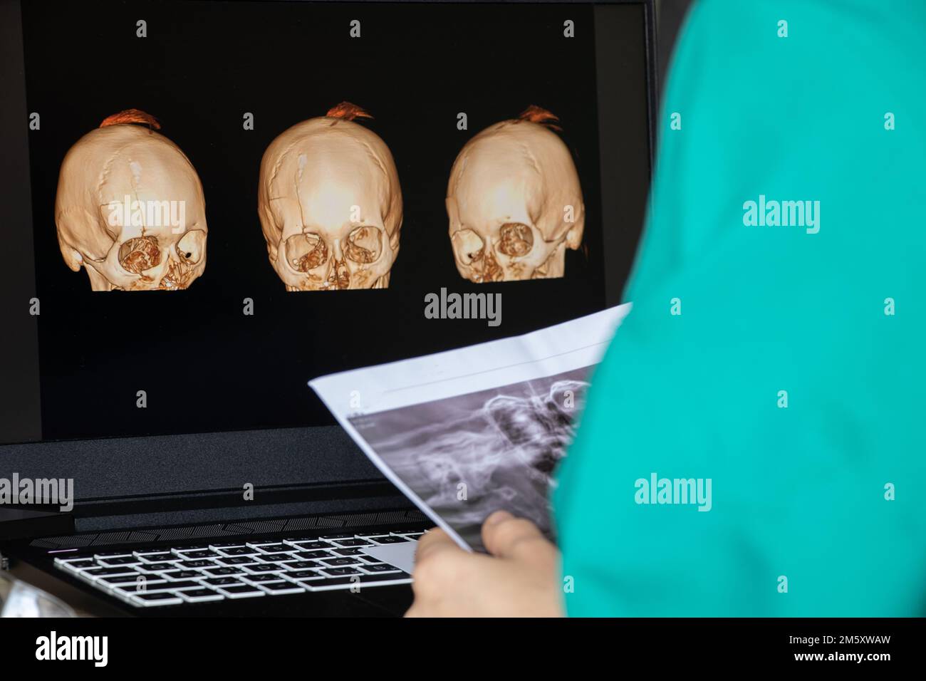 3D Computertomographie des Gehirns mit einem Bruch des frontalen Schädelteils nach einer Verletzung auf Laptop-Bildschirmen auf dem Tisch auf Laptop-Bildschirmen bei Stockfoto