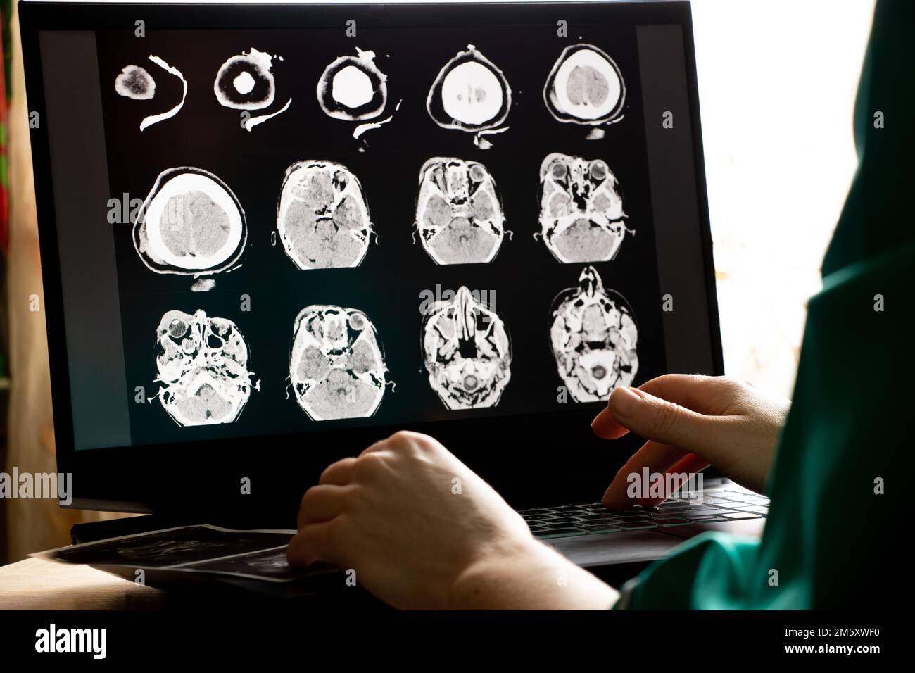 3D Computertomographie des Gehirns mit einem Bruch des frontalen Schädelteils nach einer Verletzung auf Laptop-Bildschirmen auf dem Tisch auf Laptop-Bildschirmen bei Stockfoto