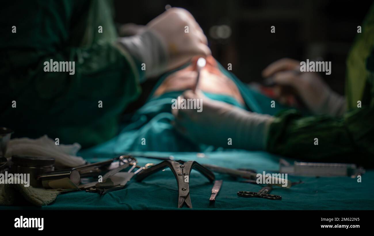 Rhinoplastik-Chirurgie, Defekte der Nasenform bei der Patientin. Chirurgische Eingriffe bei plastisch-chirurgischen Rhinoplastiken Stockfoto