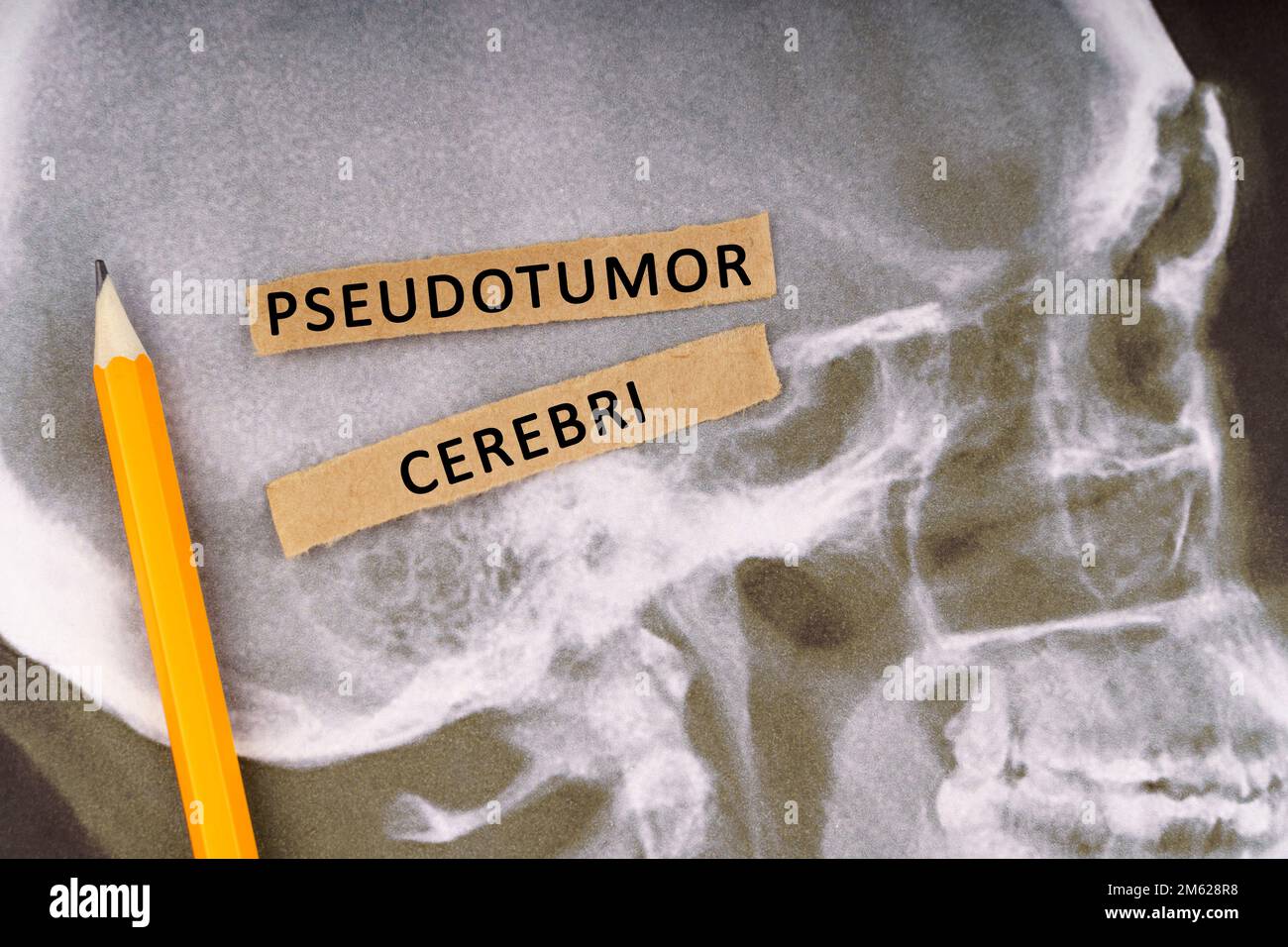 Medizinisches Konzept. Uber Röntgenbilder eines menschlichen Schädels, Bleistift und Papierstreifen mit der Inschrift - Pseudotumor cerebri Stockfoto