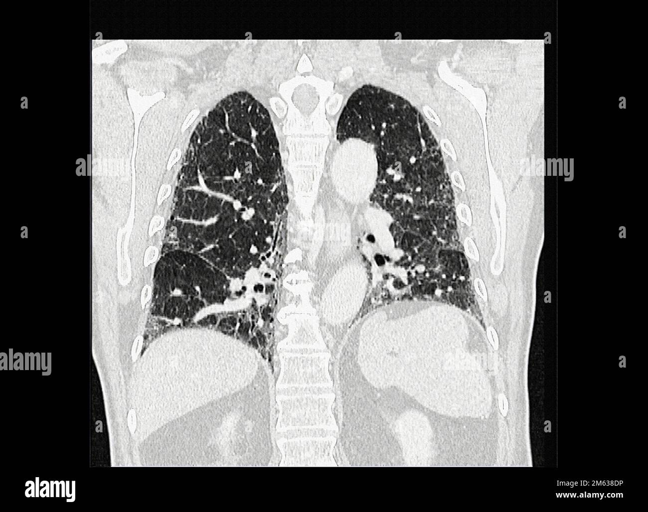 Tomographie der an interstitieller Pneumonie leidenden Lungen. Computertomographie (CT) ist eine