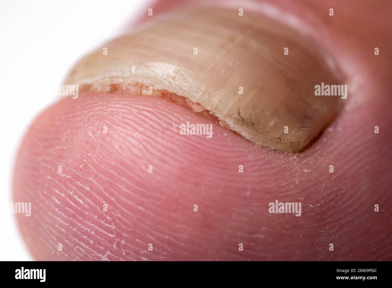 Nahaufnahme eines Fingers mit Nagelpilzinfektion, Stockfoto