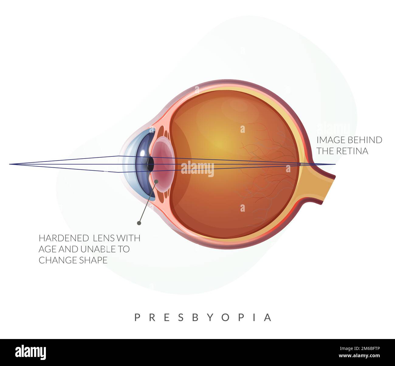 Presbyopie – Anatomie des menschlichen Auges – Bestandsdarstellung als EPS 10-Datei Stock Vektor