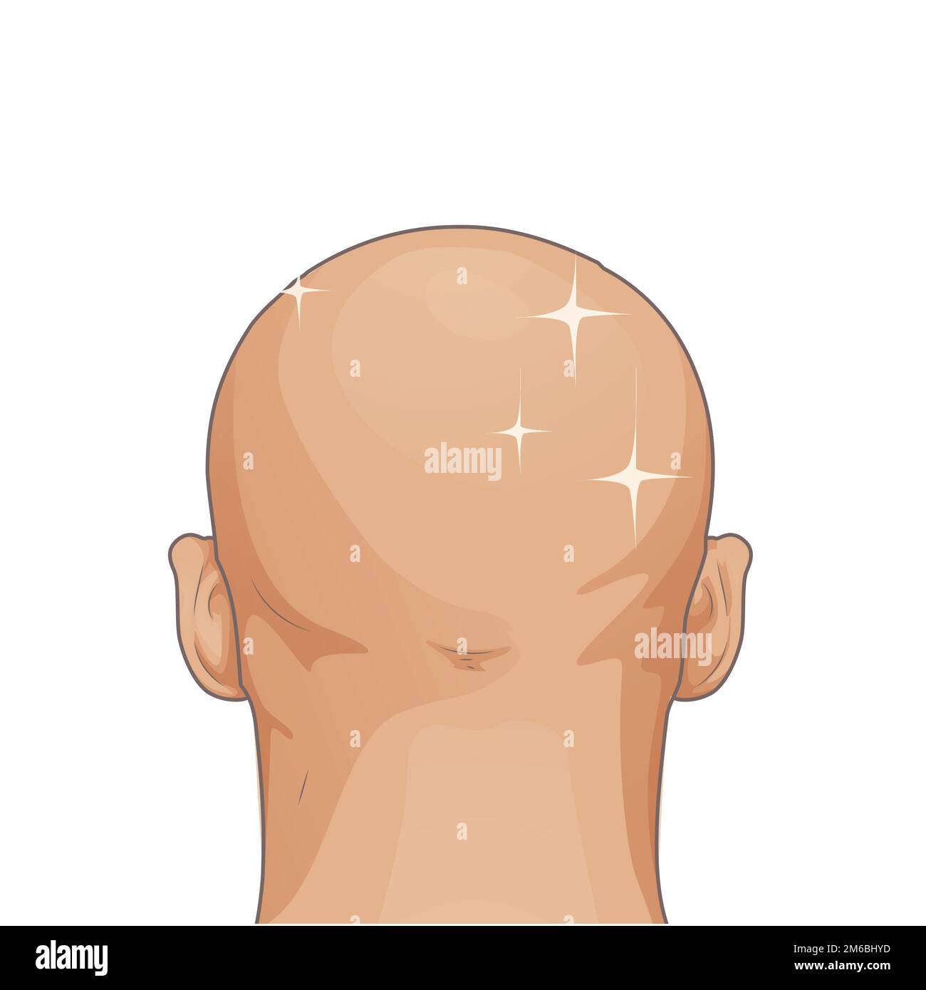 Haarausfall. Stadien der Alopezie Mann Problem Vektor medizinische Gesundheit Illustration vorher danach Stock Vektor