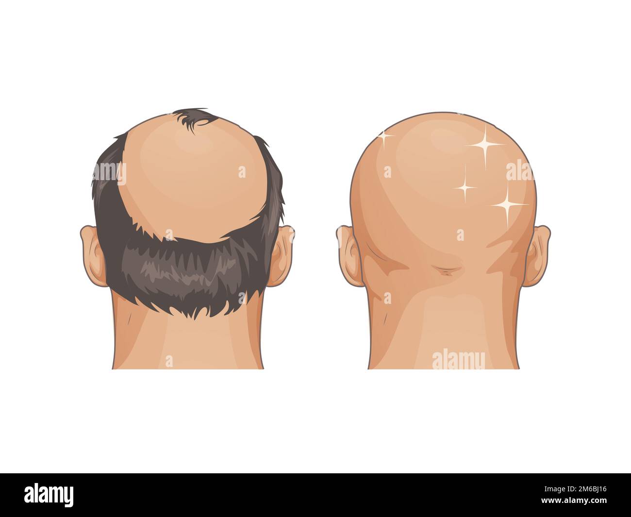 Mann mit Haarausfall Problem isoliert auf weißem Hintergrund, Zeichentrickstil auf weiß Stock Vektor