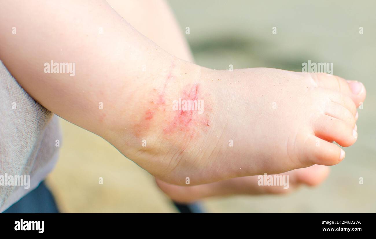 Juckende Dermatitis atopischer Babyfuß Stockfoto